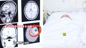 廣州24歲女生症狀離奇 流利英語突然說不出口