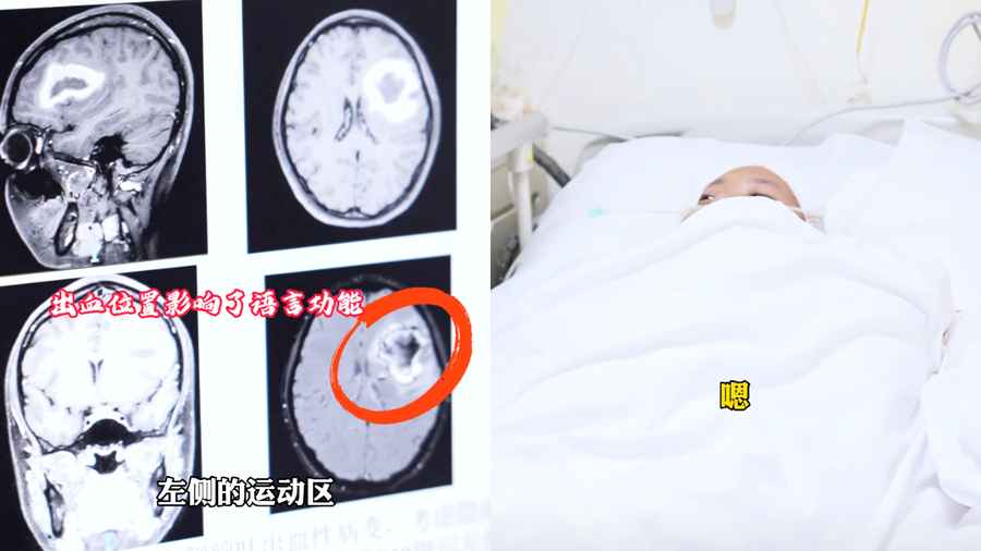 廣州24歲女生症狀離奇 流利英語突然說不出口