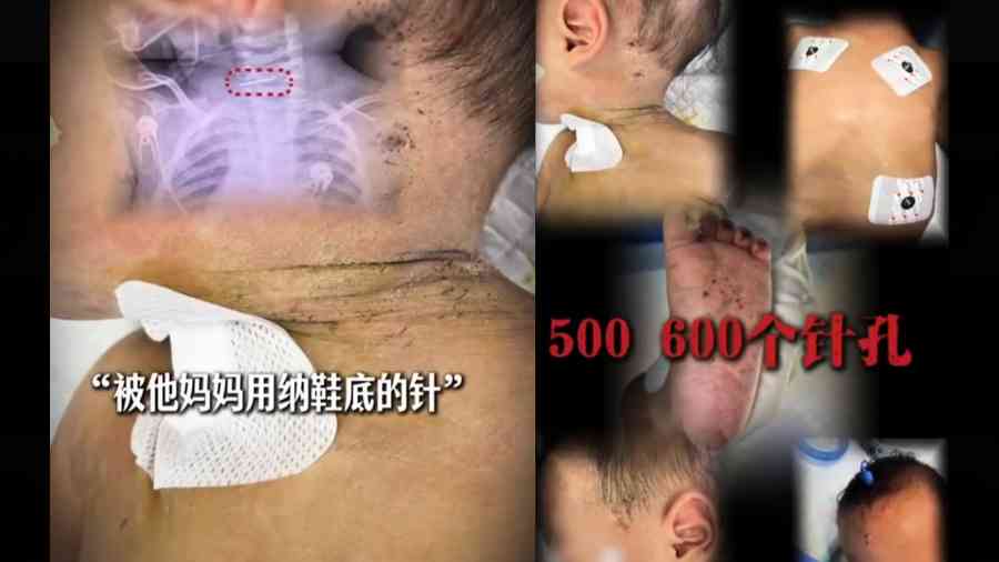 慎入！中國10個月大男嬰遭母親扎數百針 全身留針孔