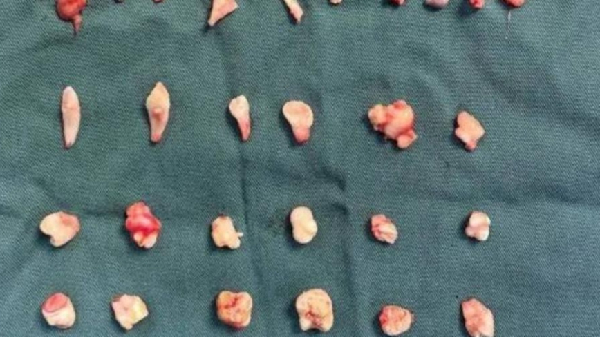18歲女孩突然腹痛 就醫驚見12cm腫瘤內藏24顆牙齒