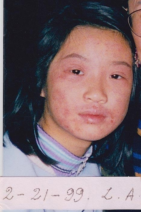 照片攝於一九九九年二月，長達四年的皮炎還相當嚴重。（明慧網）